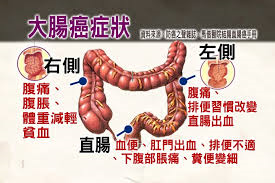 大腸癌篩檢有助保命