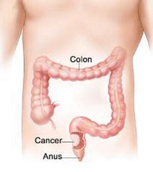 colon-cancer-2